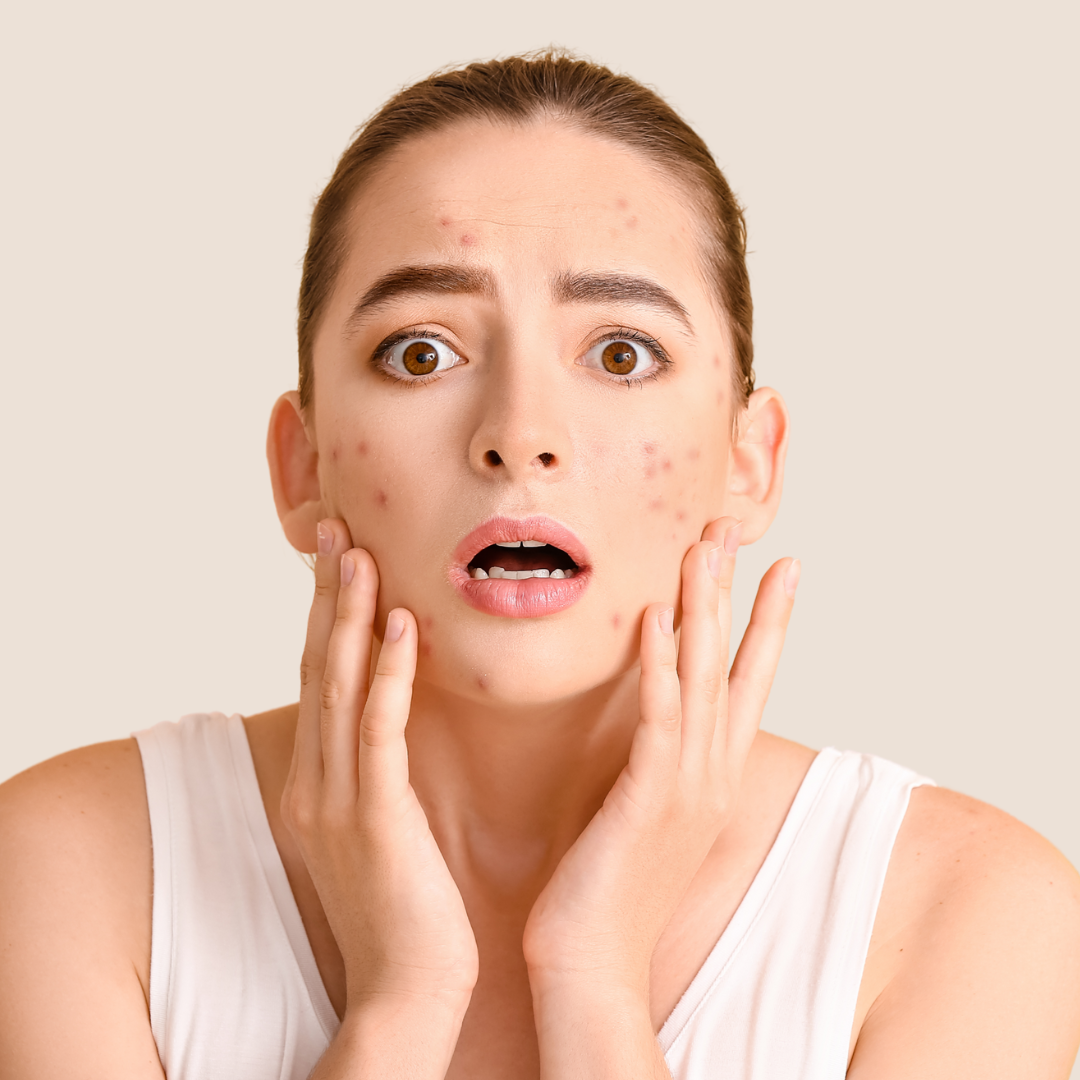 Say Goodbye to Acne – Your Clearer Skin Starts Here