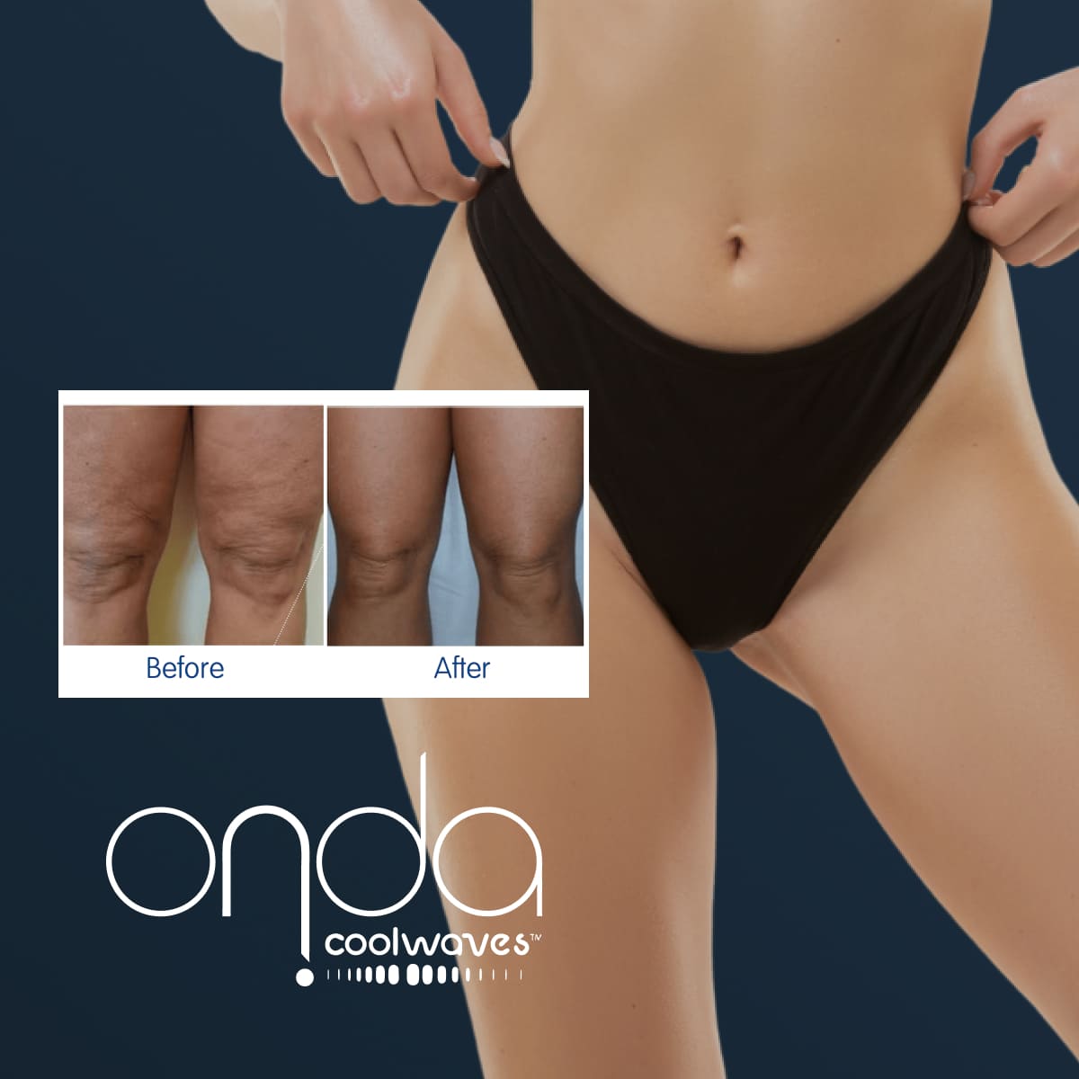 ONDA Coolwaves Body treatment with model image and before and after
