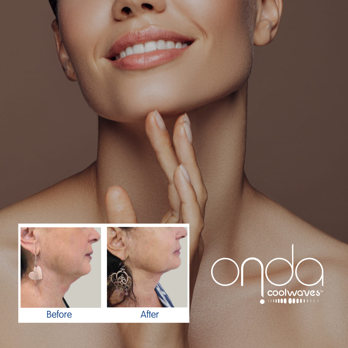 ONDA Coolwaves Face Treatment with model image and before and after